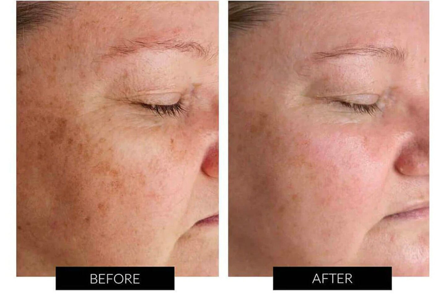 dermalux flex avant apres hyperpigmentation tache vieillesse